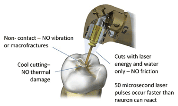 Applications of Laser Dentistry 