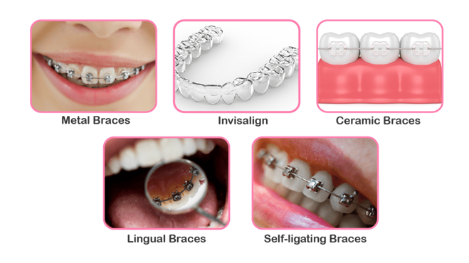 Orthodontic Treatment in Chembur