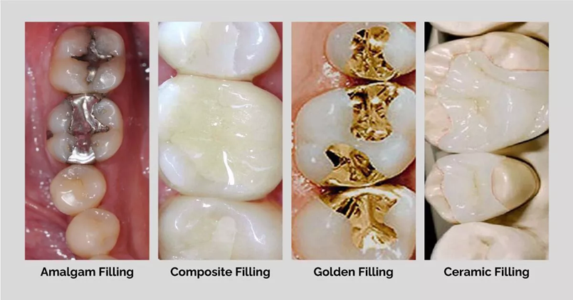 Types of Dental Fillings