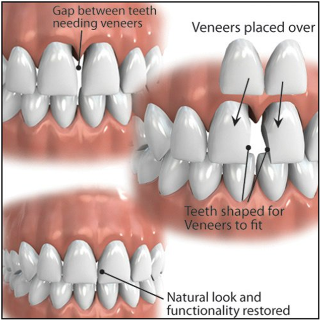 What Are Veneers and Laminates