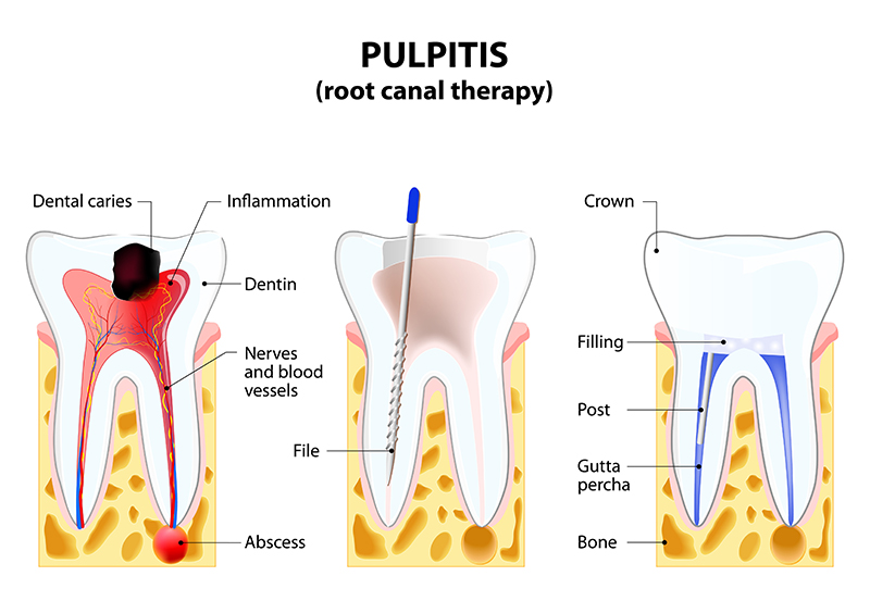 Single Tooth Dental Implant