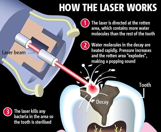 What is Laser Dentistry?