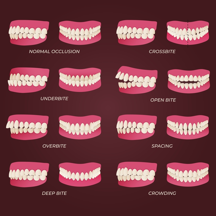 What is Orthodontic Treatment