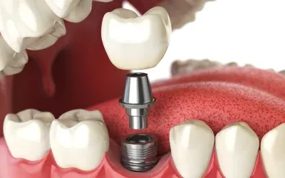 dental implants