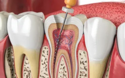 root canal