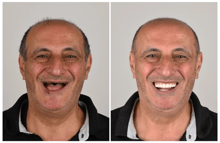 Single Tooth Dental Implant