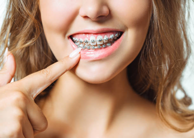 Braces After 1 Month – What to Expect and How to Manage It