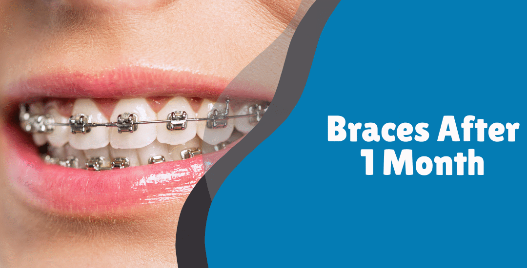 Braces After 1 Month – What to Expect and How to Manage It