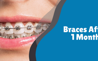 Braces After 1 Month – What to Expect and How to Manage It