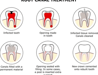 Is Root Canal Treatment Painful? Expert Dentist in Chembur Explains