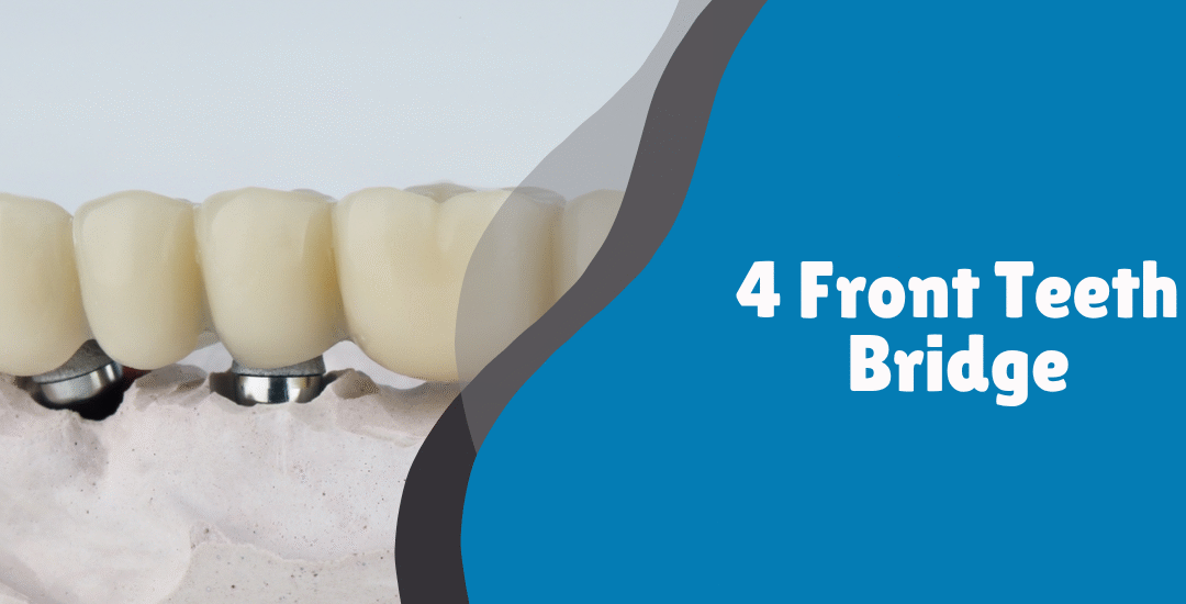 4 Front Teeth Bridge: Restoring Strength, Aesthetics, and Confidence