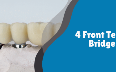 4 Front Teeth Bridge: Restoring Strength, Aesthetics, and Confidence