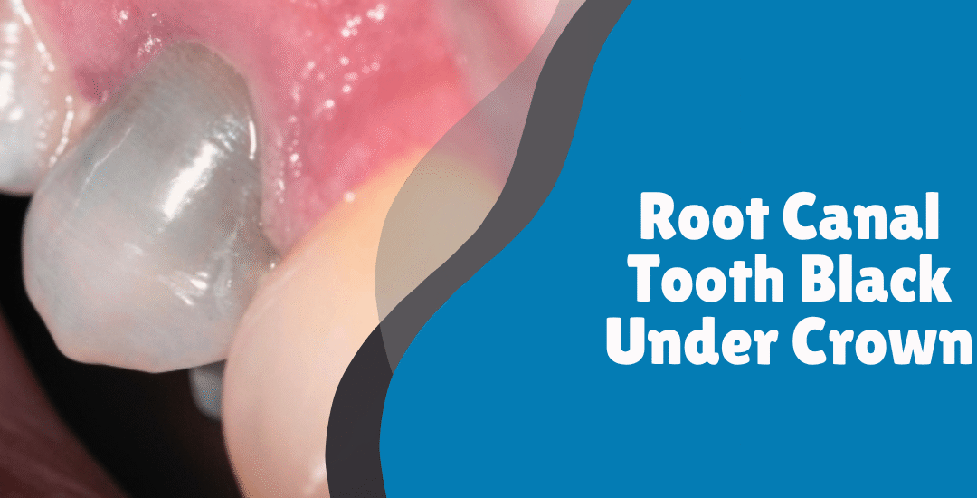 Root Canal Tooth Black Under Crown