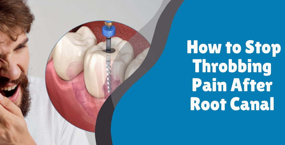 How to Stop Throbbing Pain After Root Canal | Evershine Dental Clinic