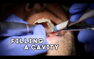 Dental Fillings in Chembur: Early Signs of Cavities You Should Never Ignore