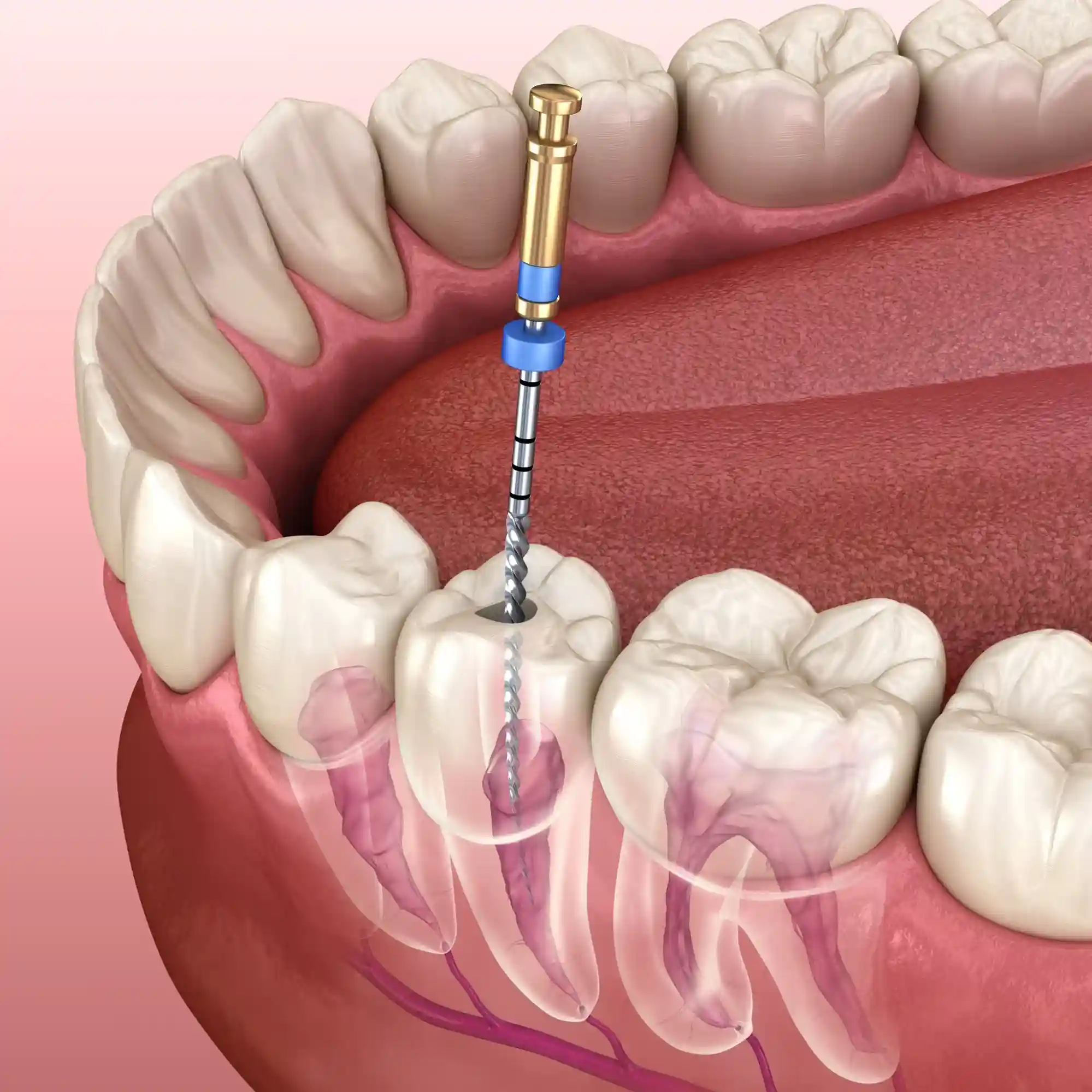 root canal treatment