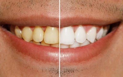Teeth Whitening in Chembur: Cost, Results, Safety & How Long It Lasts