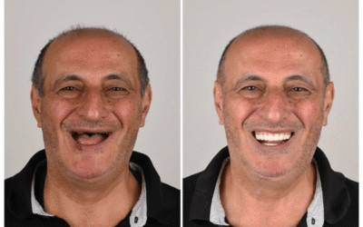 Dental Implant Cost in Chembur: Types, Procedure, Recovery & Complete Guide