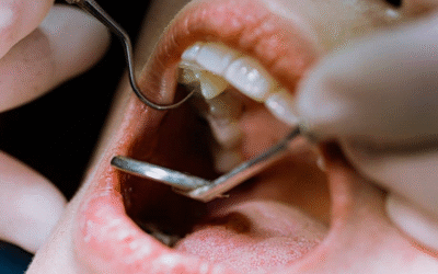 Root Canal Treatment Cost in Chembur: Procedure, Recovery & What to Expect in 2026